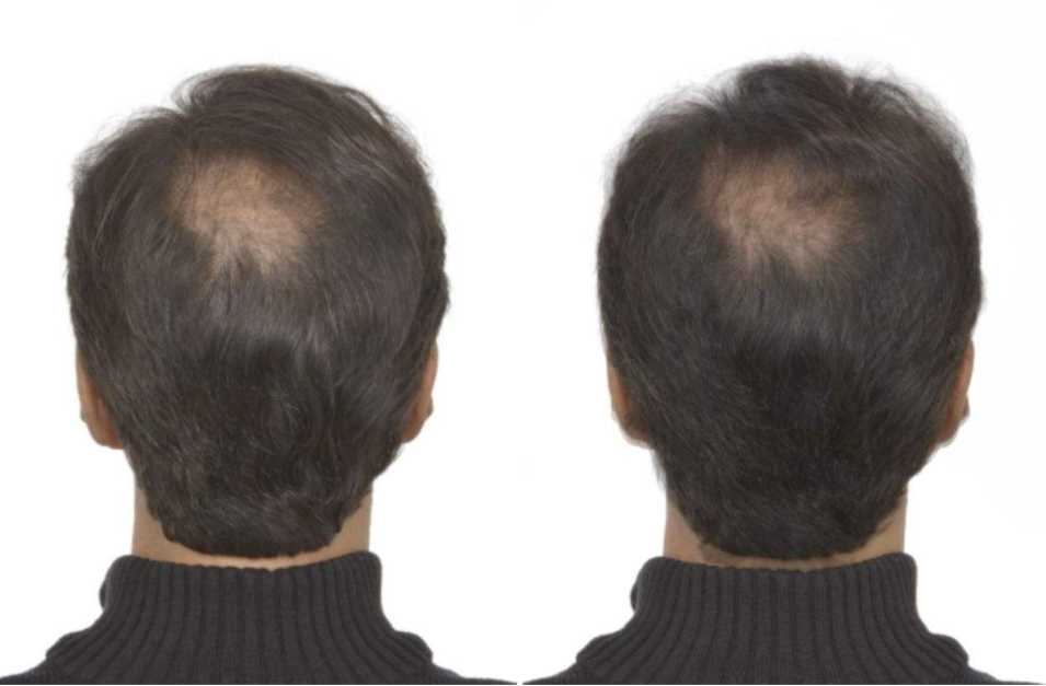 脱发与遗传有关联吗？